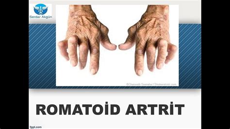 artrit sonrası çömelme nasıl